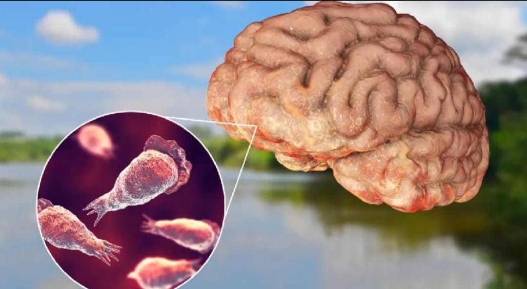 11 വയസ്സുകാരന് അമീബിക് മസ്തിഷ്ക ജ്വരം; മലപ്പുറത്ത് ജാഗ്രത നിർദേശം