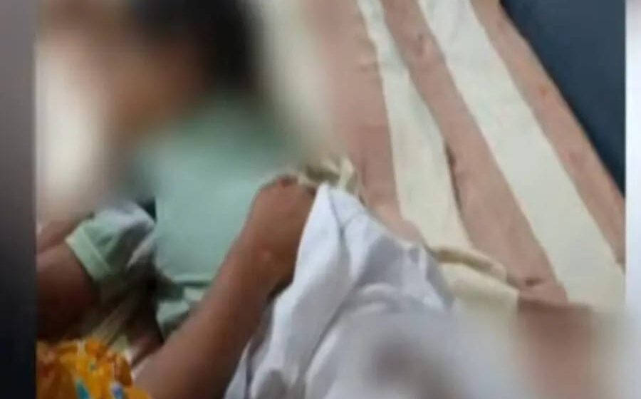 ഞെട്ടിക്കുന്ന ശിക്ഷ: കുഞ്ഞിനെ ചട്ടുകം കൊണ്ട് പൊള്ളിച്ചു;