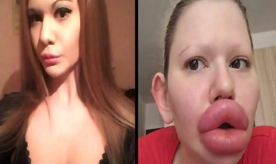 ലോകത്തിലെ ഏറ്റവും വലിയ ചുണ്ടിനായി 23 ലക്ഷം!