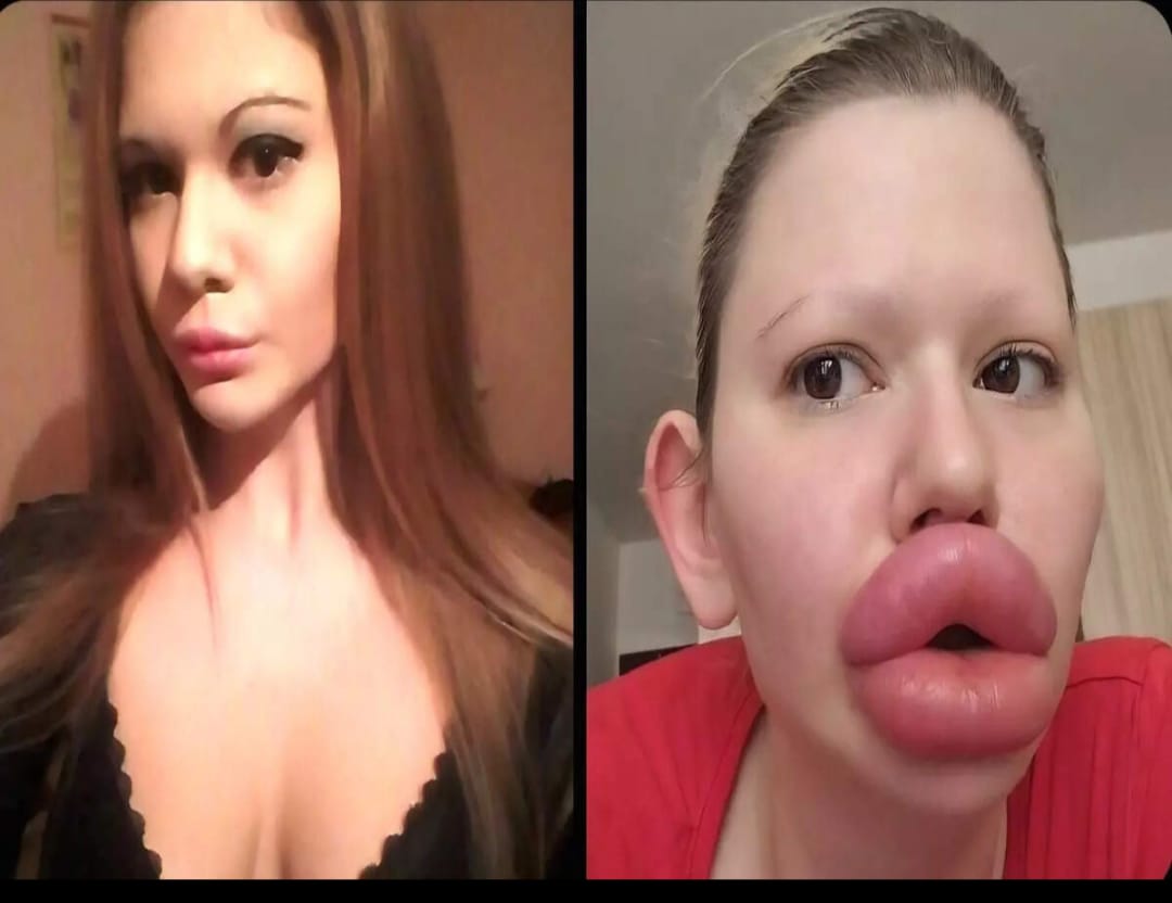 ലോകത്തിലെ ഏറ്റവും വലിയ ചുണ്ടിനായി 23 ലക്ഷം! യുവതിയുടെ സൗന്ദര്യ ഭ്രമം അതിരു കടക്കുന്നു